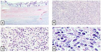 Case report: Splenic inflammatory pseudotumor-like follicular dendritic cell sarcoma (IPT-like FDCS): a trial of immunotherapy and review of the literature